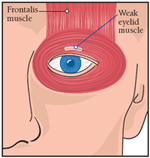 weak eyelid muscle