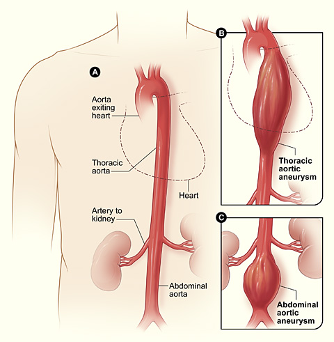 Figure A shows a normal aorta. Figure B shows a thoracic aortic aneurysm (which is located behind the heart). Figure C shows an abdominal aortic aneurysm located below the arteries that supply blood to the kidneys.