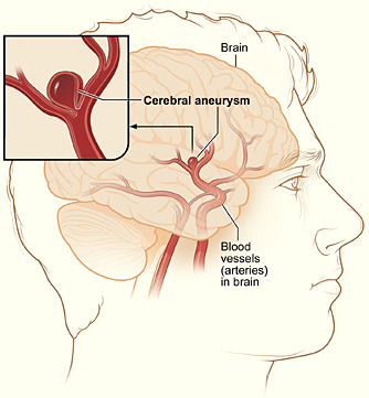 The illustration shows a typical location of a brain (berry) aneurysm in the arteries supplying blood to the brain. The inset image shows a closeup view of the sac-like aneurysm.