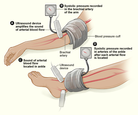 The illustration shows the ABI test. The ABI compares blood pressure in the ankle to blood pressure in the arm. As the cuff deflates, the blood pressure in the arteries is recorded.