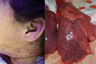 LEFT:Petechial rash caused by RMSF. RIGHT:Pulmonary hemorrhage observed during autopsy.