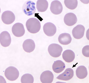 Giemsa-stained thin blood smear with schizonts (block arrow) and ring forms (thin arrow) of P. knowlesi from the reported case.
