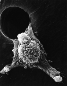 Scanning electron micrograph of cancer cell.