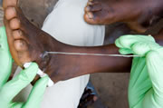 Photo of guinea worm being extracted from a person's foot