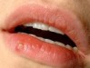 A photograph of lips with a cold sore