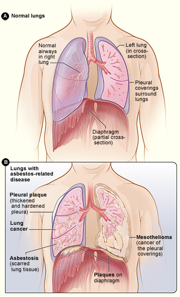 Figure A shows the location of the lungs, airways, pleura, and diaphragm. Figure B shows lungs with asbestos-related diseases, including pleural plaque, lung cancer, asbestosis, plaque on the diaphragm, and mesothelioma. 