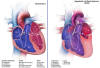 Hypoplastic Left Heart Syndrome - Click here to see a larger image.