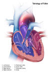 Tetralogy of Fallot - Click here to see a larger image.