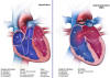 Atrial Septal Defect - Click here to see a larger image.