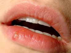 a photograph of lips with a cold sore