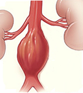 Ilustración de un aneurisma aórtico abdominal