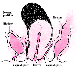 Uterine Prolapse