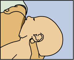 Picture of how to bring baby to breast: Watch the lower lip and aim it as far from base of nipple as possible, so the baby takes a large mouthful of breast.