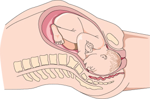 Diagram of a baby in the birth canal