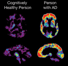 PET scans showing higher Pittsburgh Compound B uptake in the brain of a person with AD than in the brain of a cognitively healthy person