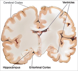 Image of a healthy brain showing the cerebral and entorhinal cortices, the hippocampus, and the ventricles.