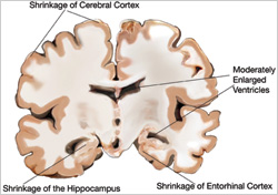 Slice of a mild to moderate AD brain showing shrinkage of the cerebral cortex, hippocampus, and entorhinal cortex, and moderately enlarged ventricles.
