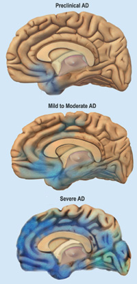 Images showing affected areas in preclinical AD, mild to moderate AD, and severe AD.