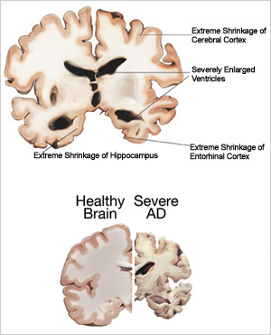 Slice of a severe AD brain showing extreme shrinkage of the cerebral cortex, hippocampus, and entorhinal cortex, and severely enlarged ventricles. Also shown are side-by-side slices of a healthy brain and a severe AD brain, with the healthy brain significantly larger than the severe AD brain.