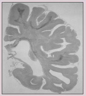 Nerve fiber deterioration in an inhalant abuser