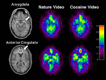 Positron Emission Tomography