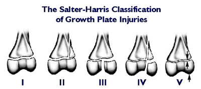 The Salter-Harris Classification of Growth Plate Injuries, Types I - V