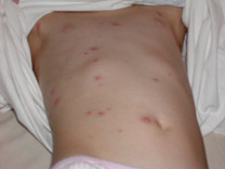 Abdomen of child with breakthrough varicella lesions.