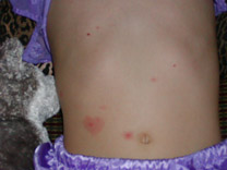 Abdomen of child with breakthrough varicella lesions (second image)