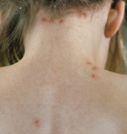 Back of child with breakthrough varicella