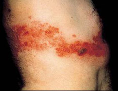 typical dermatomal rash with hemorrhagic vesicles