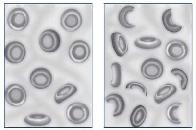 Two drawings of red blood cells. In the drawing on the left, the healthy cells are round and smooth. In the drawing on the right, the cells are misshapen, as seen in people with hemolytic uremic syndrome.