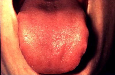 Photograph of examination of the tongue