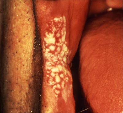 Photograph of nodular leukoplakia