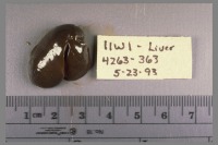 enlargement and discoloration of the liver