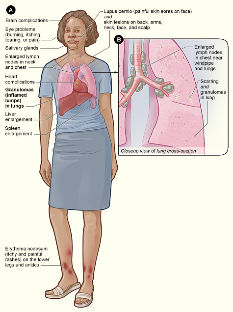 The illustration shows the major signs and symptoms of sarcoidosis (as described in this section) and the organs involved.