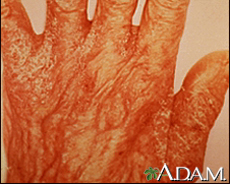 Photograph of a hand with scabies rash