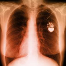 Photograph of an x-ray of the chest showing a pacemaker