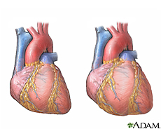 Illustration of a normal heart and  a heart enlarged due to cardiomyopathy