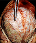 Pneumococcal meningitis in an alcoholic.