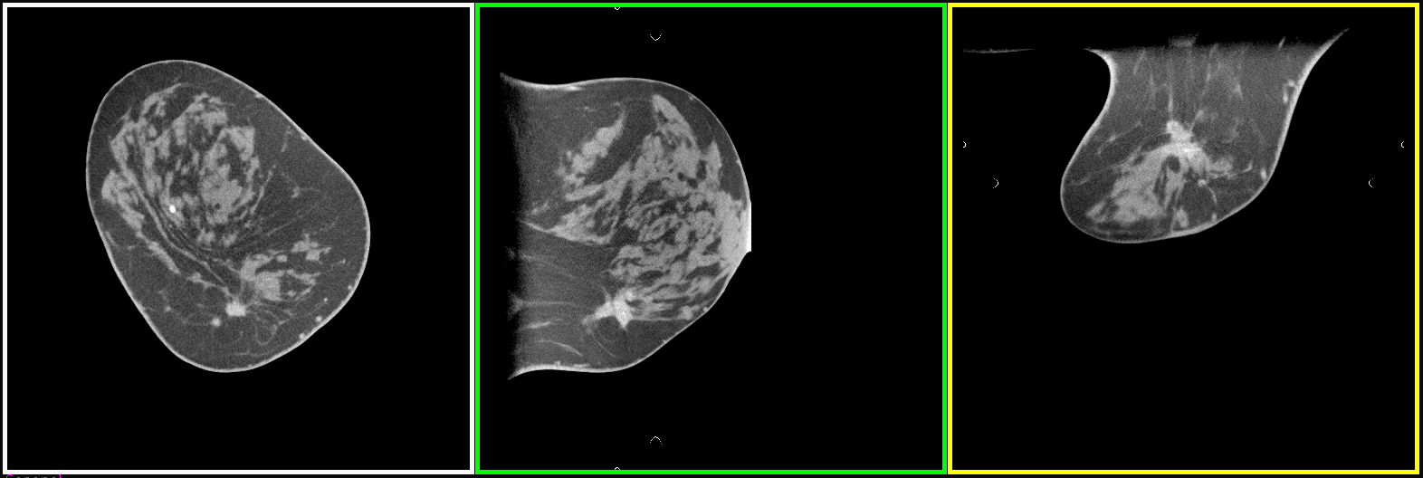 Image of breast cancer lesion detected with a dedicated breast CT scanner.