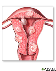 Ilustración de fibroides uterinos