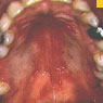 Photo: White creamy or bumpy patches (Candidiasis)