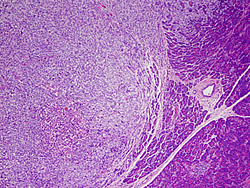 Micrograph of metastatic melanoma cells, left, that have invaded pancreatic tissue, right. Credit: Dr. Richard Lee, National Cancer Institute (NCI)