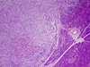 Metastatic Melanoma Cells