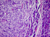 Metastatic Melanoma Cells