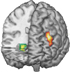 MRI of brain highlighting differential brain activity