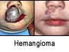 before and after of hemangioma