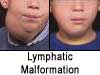 before and after of lymphatic malformation