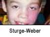 sturge-weber syndrome