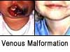 before and after of venous malformation